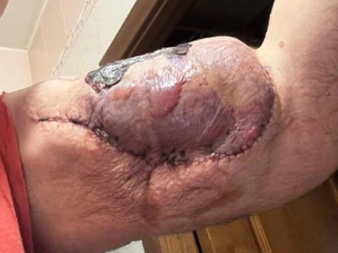 VĐV thể hình Nga nguy cơ cắt bỏ cả hai tay vì tiêm hóa chất Cánh tay của Kirill Tereshin. Ảnh: Newsx