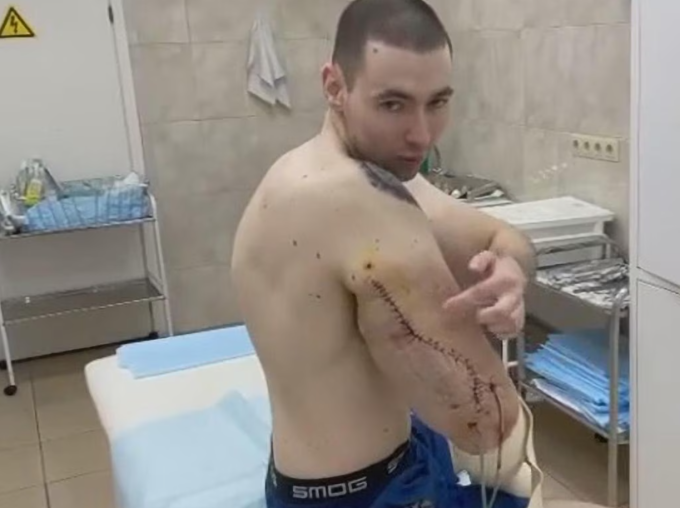 VĐV thể hình Nga nguy cơ cắt bỏ cả hai tay vì tiêm hóa chất Tereshin khoe cánh tay sau ca phẫu thuật. Ảnh: Newsx