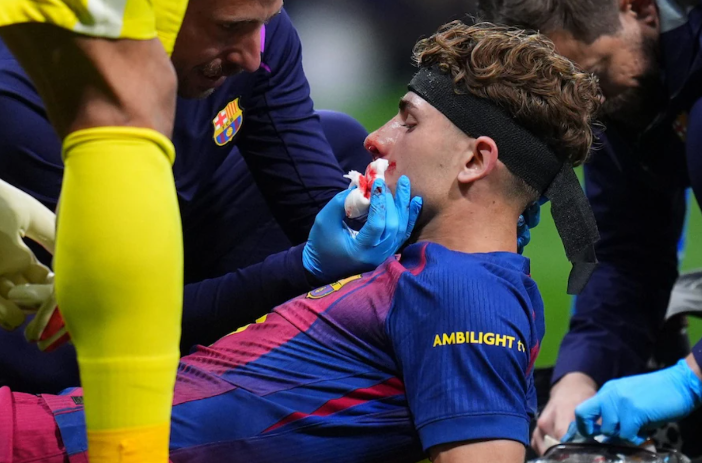 Fermin Lopez chảy nhiều máu và được băng bó ngay trên sân Lopez được các nhân viên y tế xử lý vết thương